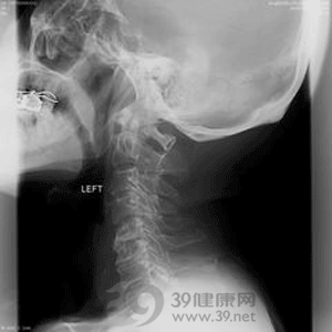 详解颈椎病病理基础