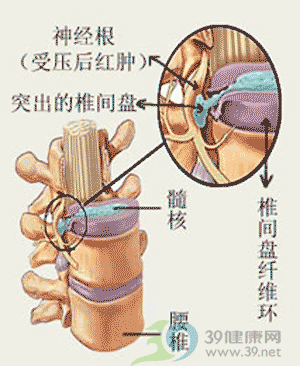 各种腰椎间盘突出症的治疗