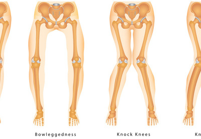 赶走橘皮 塑造性感翘臀