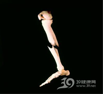 骨折康复期要“动静结合”