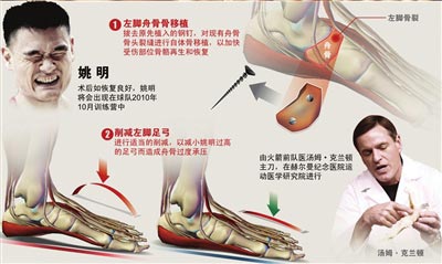 姚明手术成功:骨头裂缝已嫁接 左脚足弓被削平 姚明手术成功:骨头裂缝已嫁接 左脚足弓被削平