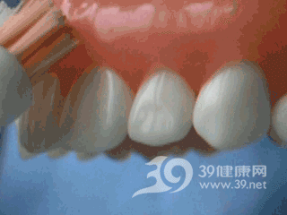 口腔健康 刷牙不是全部 还必须洗牙