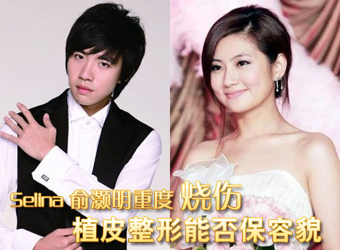 Selina 俞灏明重度烧伤 植皮整形能否保容貌