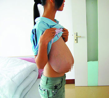 16斤巨乳女孩顺利“减负” 手术达7个多小时 16斤巨乳女孩顺利“减负” 手术达7个多小时