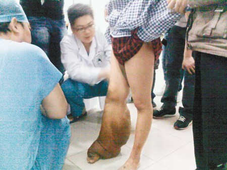 少女小腿粗如“象腿” 抬脚行走如拖一袋面 少女小腿粗如“象腿” 抬脚行走如拖一袋面