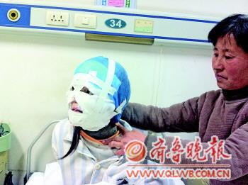 济南12岁女孩全身长满“兽皮” 已完成面部整容 济南12岁女孩全身长满“兽皮” 已完成面部整容
