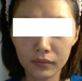自体脂肪干细胞面部填充经历（图）_整形