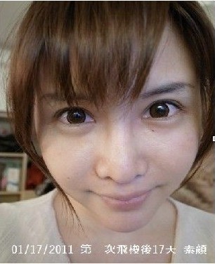 实拍台湾热门整容项目飞梭镭射全程_整形
