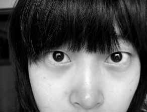 专家点评女网友双眼皮手术的全过程_整形