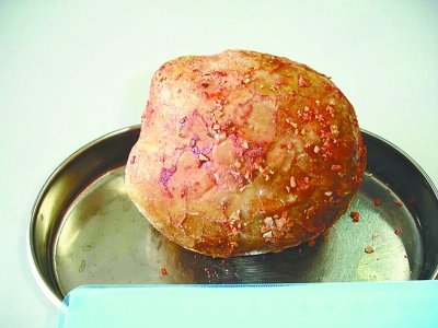 男子膀胱取出1公斤罕见结石 身怀多年不知(图) 男子膀胱取出1公斤罕见结石 身怀多年不知(图)