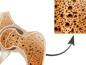 骨质疏松,骨折
