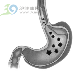 解密胃酸与胃溃疡发病关系