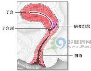 中医药更能缓解宫颈癌病人的痛苦！