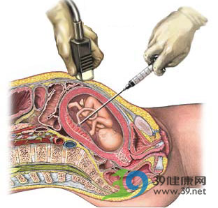 产前诊断专家李玮璟谈羊水和脐带血穿刺的作用