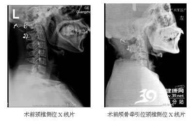 颅底凹陷症病案解析