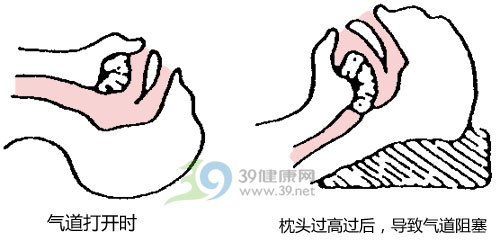 专家：治打呼 戴上面罩睡觉