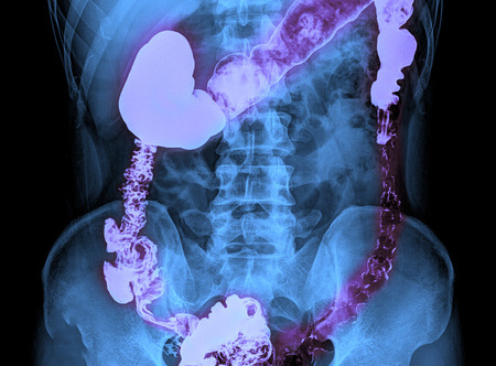 7个关键基因决定脑癌患者存活时间