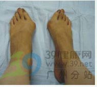 尖头鞋成美丽杀手 拇外翻当如何治疗