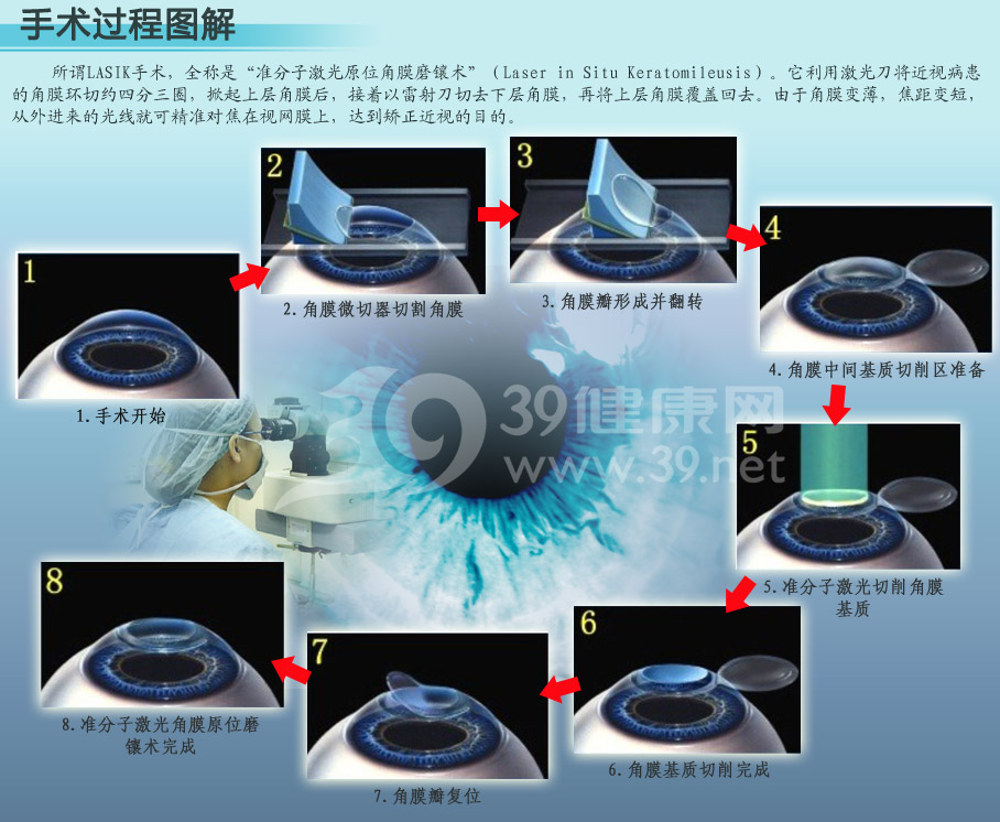 激光手术治疗近视过程