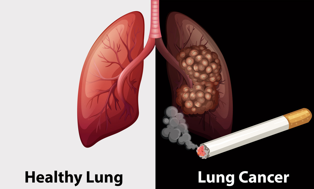 看肺癌到成都那个医院好