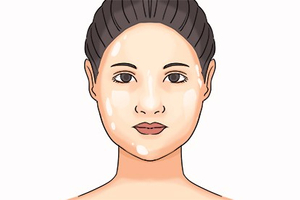 脸上白色糠疹是什么原因引起的