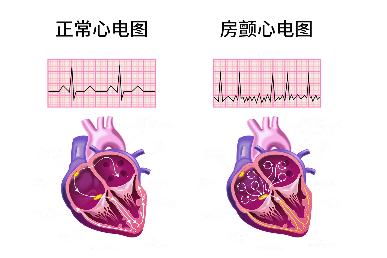 房颤为什么脉搏短绌