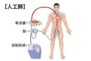 ECMO体外膜肺氧合代表什么意思