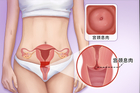 子宫颈息肉需要治疗吗
