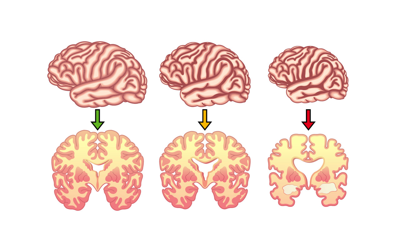 抚顺治疗阿尔茨海默病医生推荐