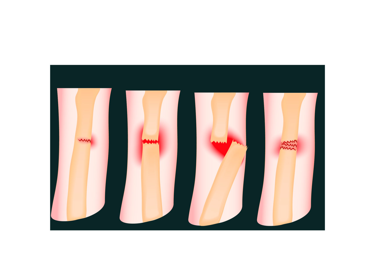 普洱哪里能治软组织损伤