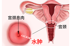 子宫内膜息肉是小手术吗