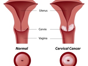 高危型人乳头瘤病毒是什么意思