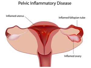 盆腔炎症