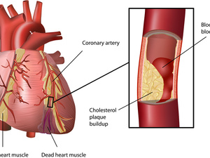 冠状动脉粥样硬化性心脏病调理方法