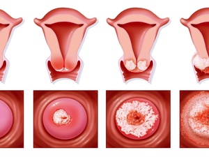 准确医治：郑州治疗HPV16专科医院发布-专治高危HPV阳性  郑州新世纪医院正