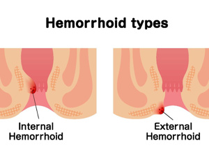 肛门内痔痔疮怎么治疗