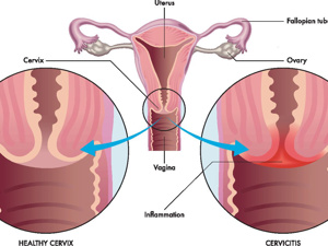 妇科炎症