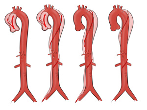主动脉夹层的早期症状和先兆症状