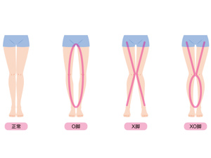 绑腿能改善X型腿和O型腿吗