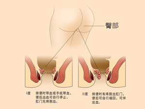 患者_痔疮