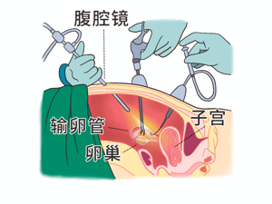 输卵管阻塞