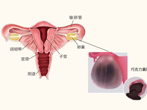 巧克力囊肿