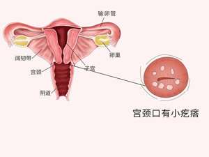 宫颈口硬