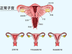 子宫_纵隔子宫