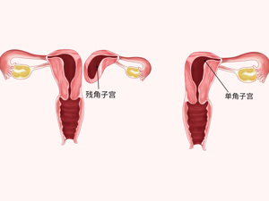 子宫_双子宫手术