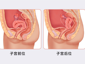 双子宫_子宫腺肌病