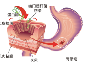 幽门螺杆菌感染