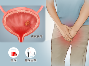 患者_膀胱肿瘤