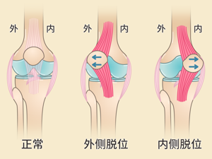 髌骨脱位