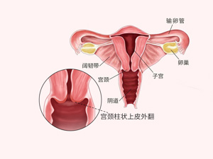 子宫颈上皮内瘤变三级